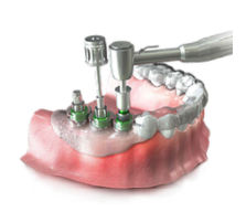 3-D Guided Implant